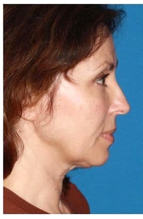 Facelift, before