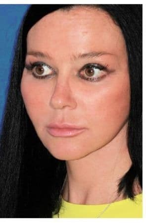 Facial Rejuvenation, after