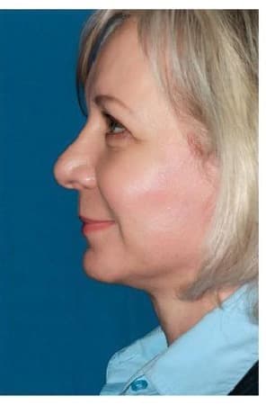 Neck Lift, after