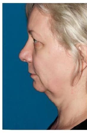 Neck Lift, before