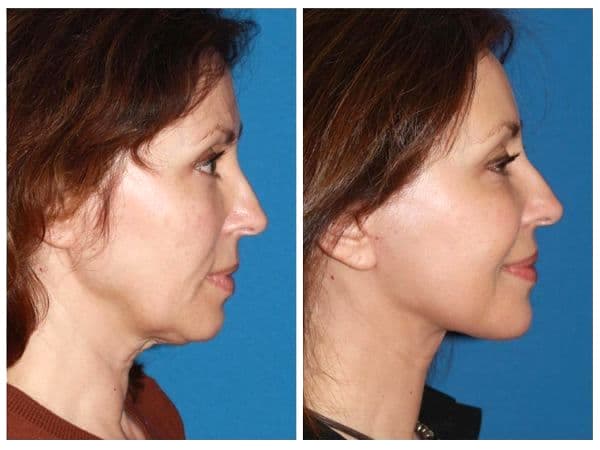 Facelift: before (left) and after (right)